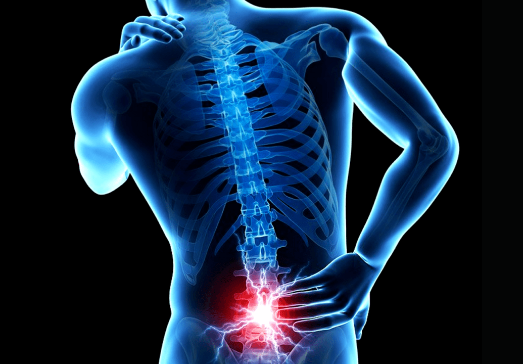 juosmens osteochondrozės požymiai