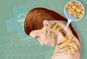 Gimdos kaklelio osteochondrozės reflekso simptomai