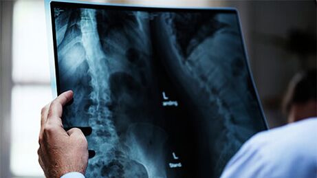 Stuburo rentgenograma su osteochondroze